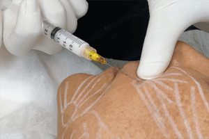 bioestimuladores de colágeno