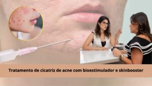 cicatriz de acne